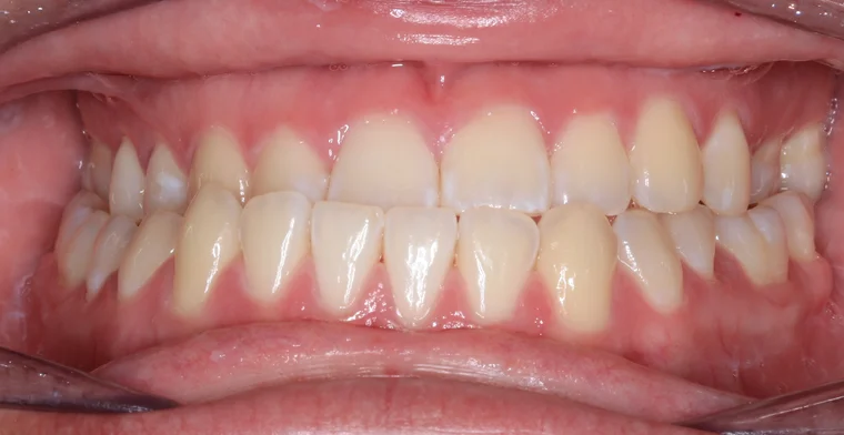 Before Metal Self-Ligating Braces & Orthognathic Surgery treatment - teeth