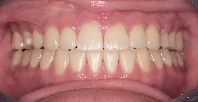After Metal Self-Ligating Braces & Orthognathic Surgery treatment - teeth