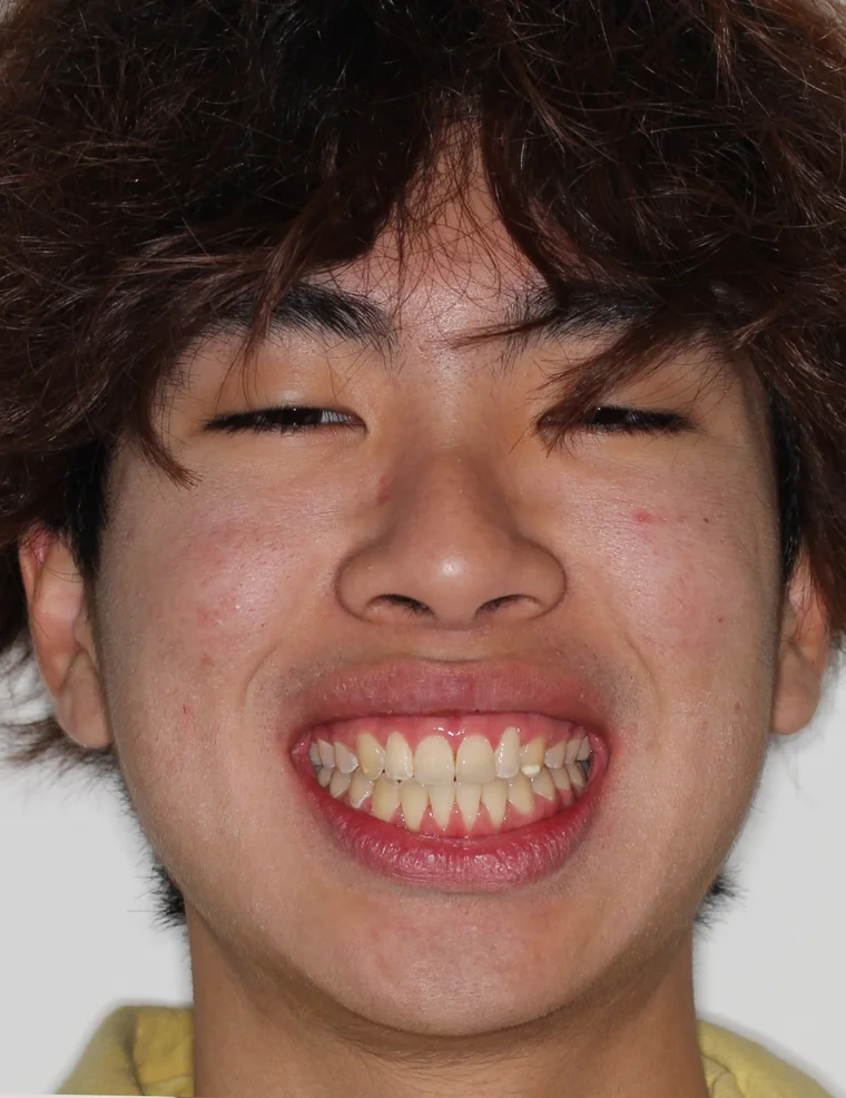 After Metal Self-Ligating Braces treatment - face