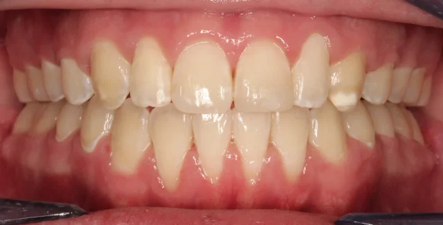After Metal Self-Ligating Braces treatment - teeth