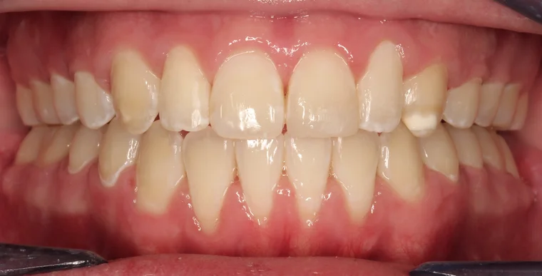 After Metal Self-Ligating Braces treatment - teeth