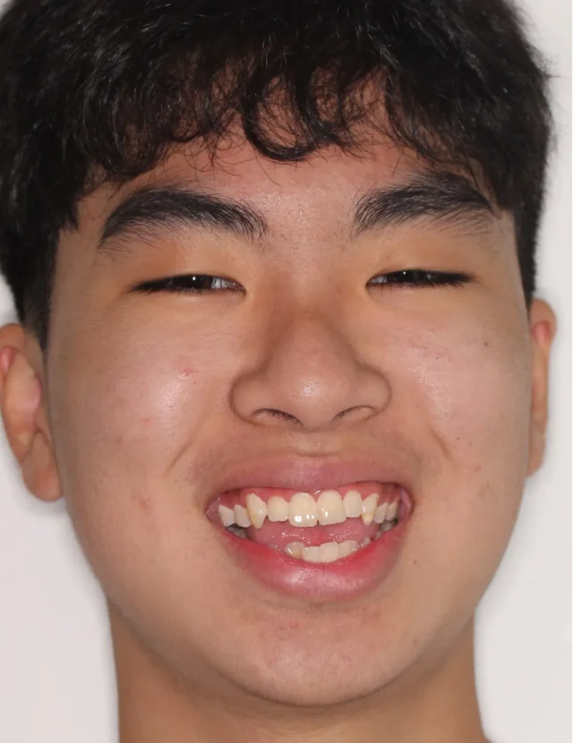 Before Metal Self-Ligating Braces treatment - face