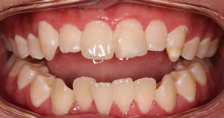 Before Metal Self-Ligating Braces treatment - teeth