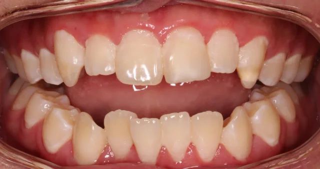Before Metal Self-Ligating Braces treatment - teeth