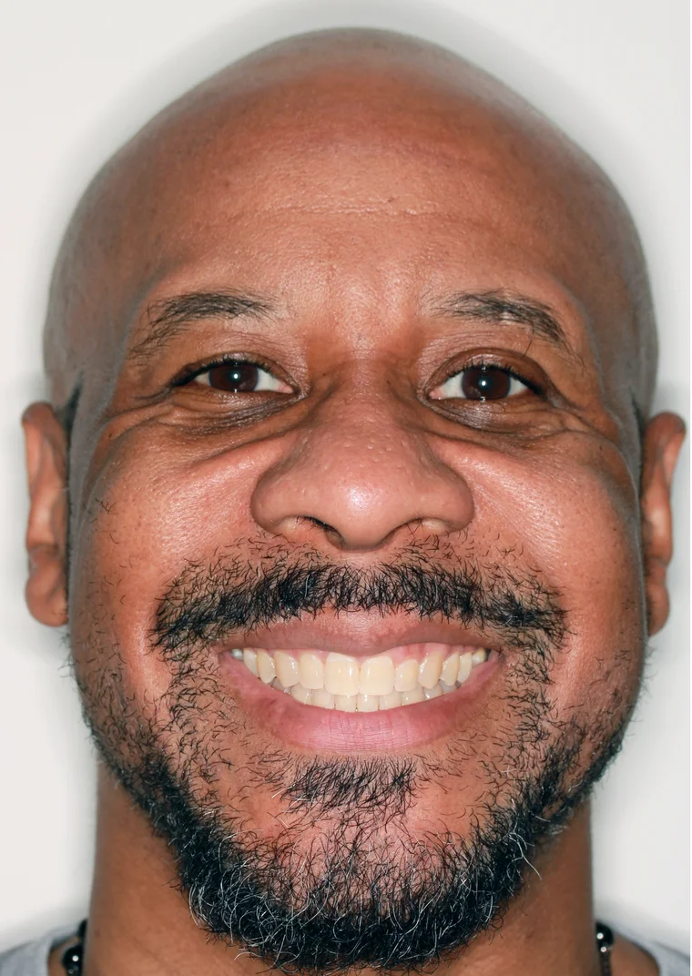 After Metal Self-Ligating Braces treatment - face