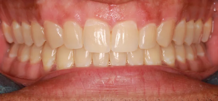 After Metal Self-Ligating Braces treatment - teeth