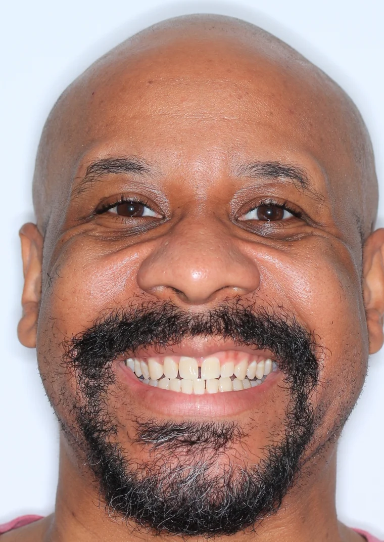 Before Metal Self-Ligating Braces treatment - face