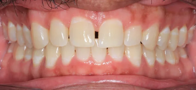 Before Metal Self-Ligating Braces treatment - teeth