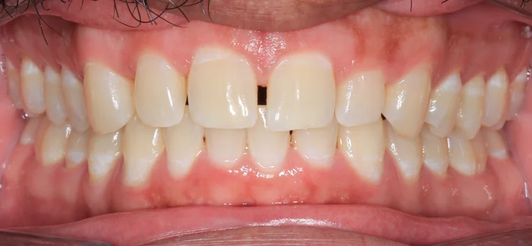 Before Metal Self-Ligating Braces treatment - teeth