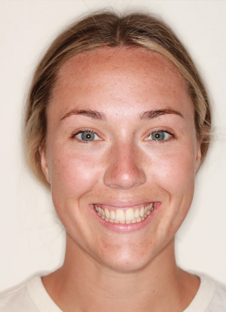 After InSmile (formerly InBrace) treatment - face