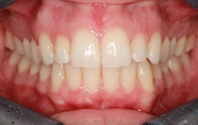After InSmile (formerly InBrace) treatment - teeth