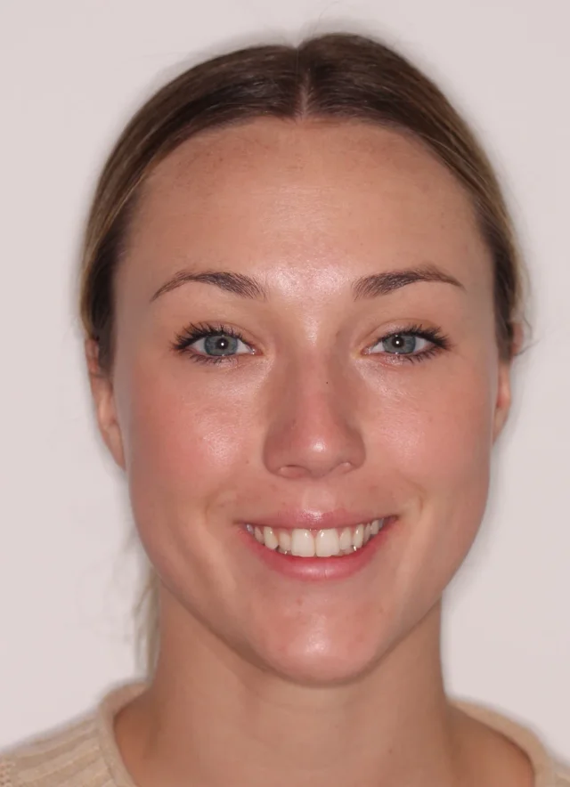 Before InSmile (formerly InBrace) treatment - face