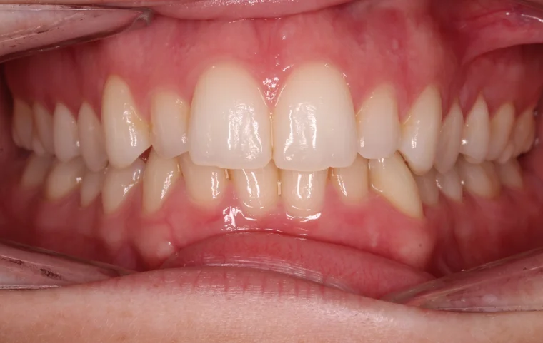Before InSmile (formerly InBrace) treatment - teeth