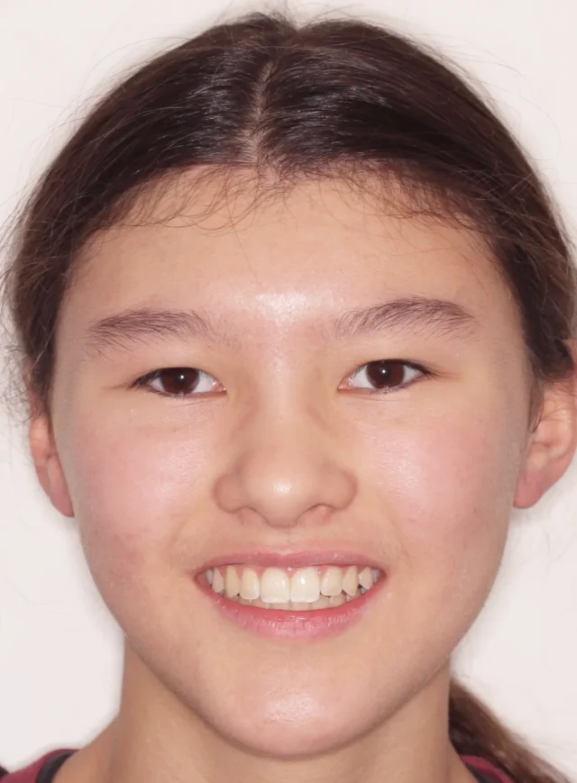 After Metal Self-Ligating Braces treatment - face