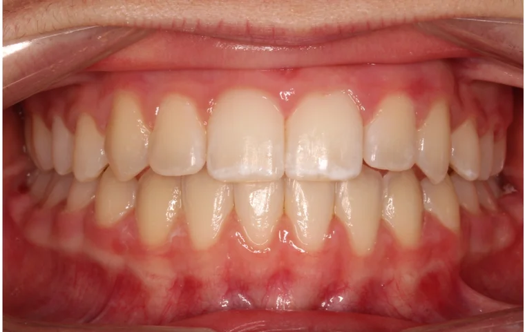 After Metal Self-Ligating Braces treatment - teeth