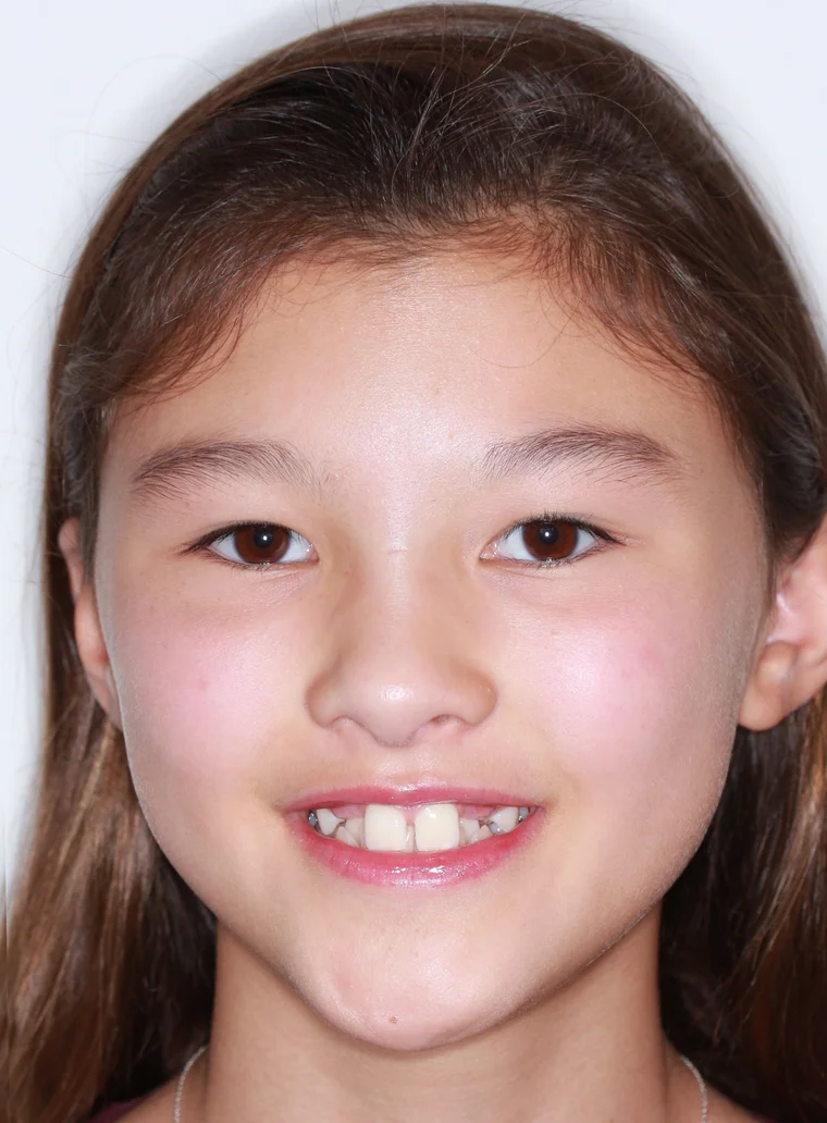 Before Metal Self-Ligating Braces treatment - face