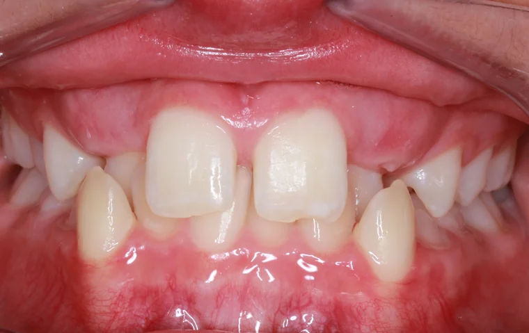 Before Metal Self-Ligating Braces treatment - teeth