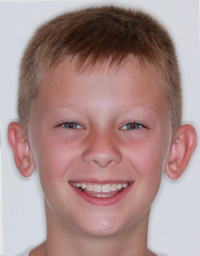 After Phase I Braces treatment - face