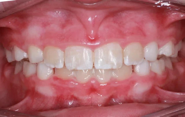 After Phase I Braces treatment - teeth