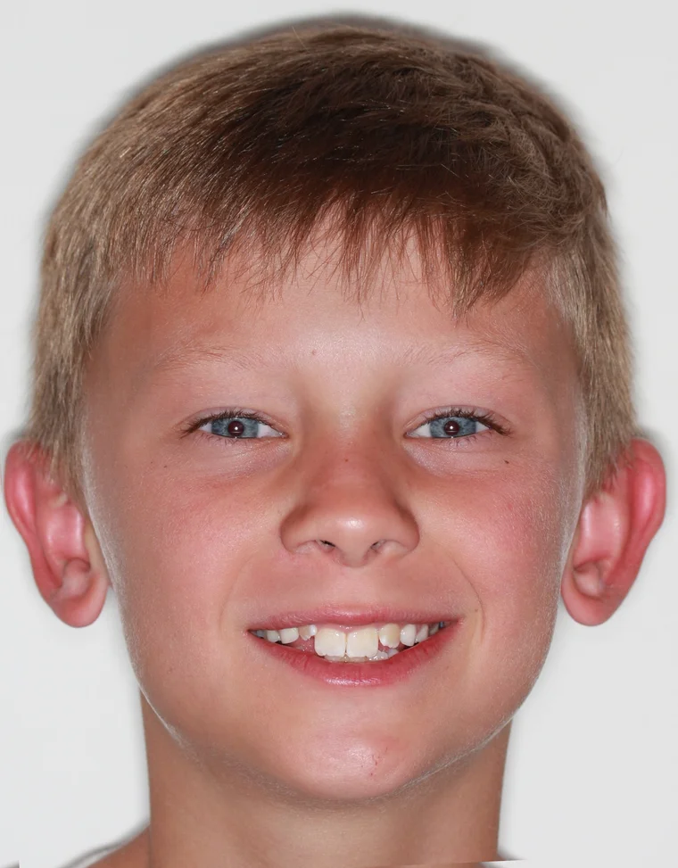 Before Phase I Braces treatment - face