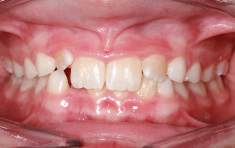 Before Phase I Braces treatment - teeth