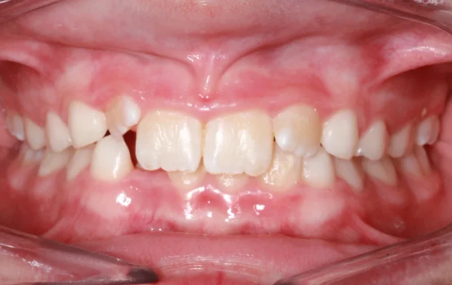 Before Phase I Braces treatment - teeth