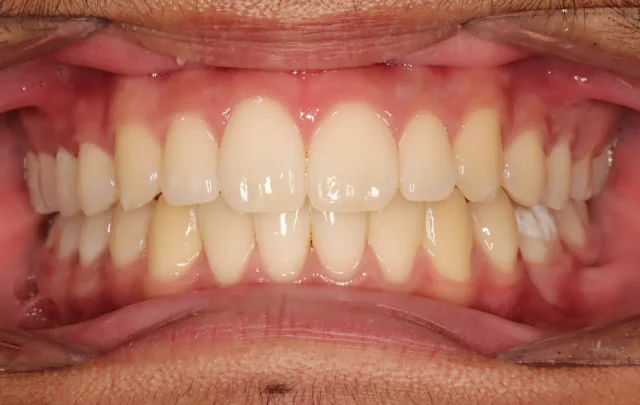 After Herbst Growth-Guidance Appliance treatment - teeth