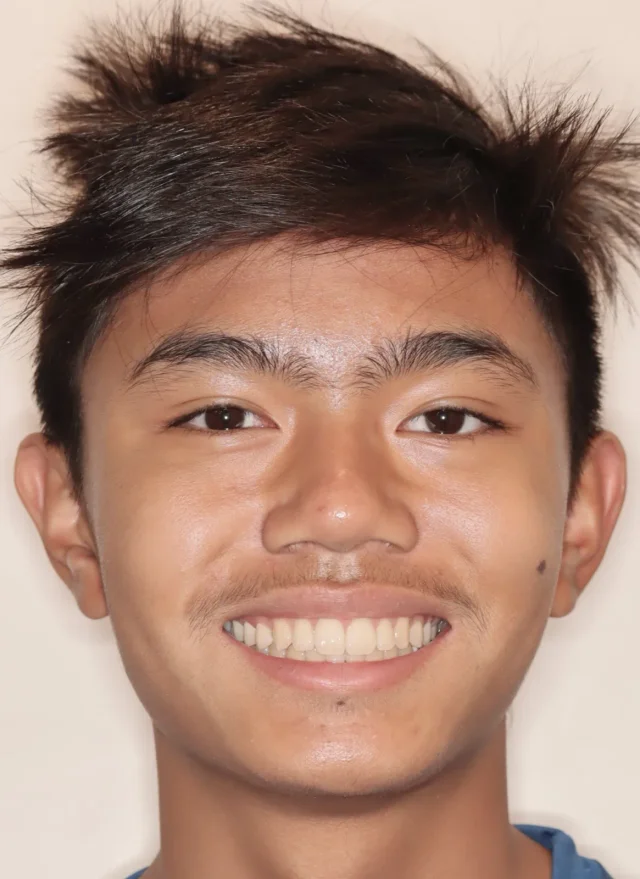 After Herbst Growth-Guidance Appliance treatment - face