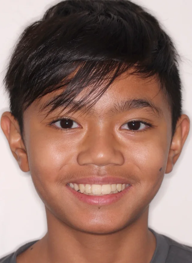 Before Herbst Growth-Guidance Appliance treatment - face