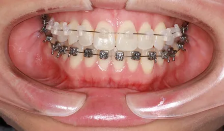 Clear Braces preview