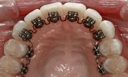 Invisible Braces (Behind Teeth) preview