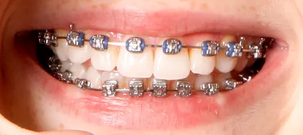 Self-Ligating Metal Braces preview