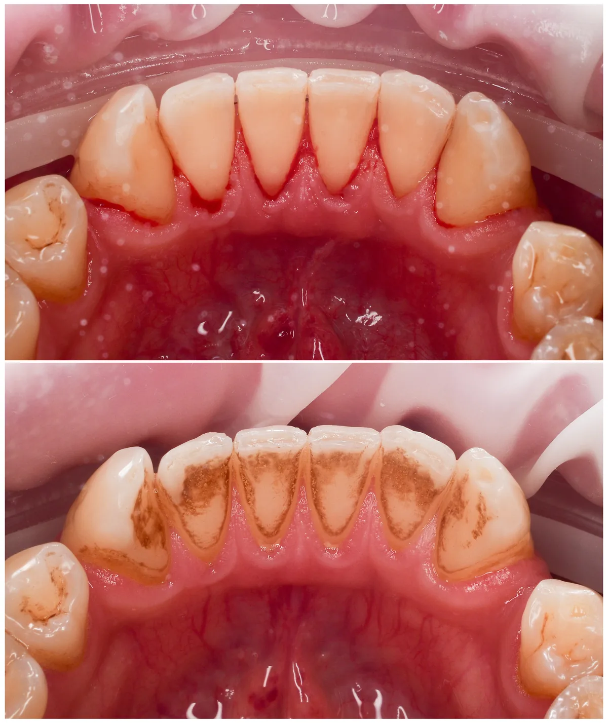 Close-up clinical comparison of plaque and calculus buildup on the lingual surfaces of lower anterior teeth versus clean teeth and healthy gums