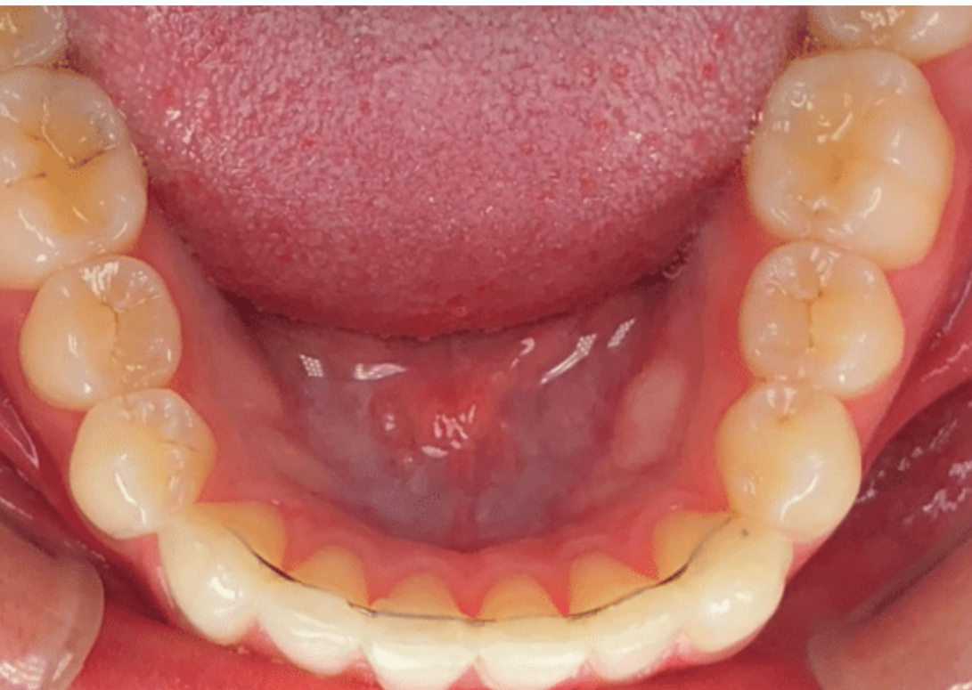 C5 (Behind Teeth) preview