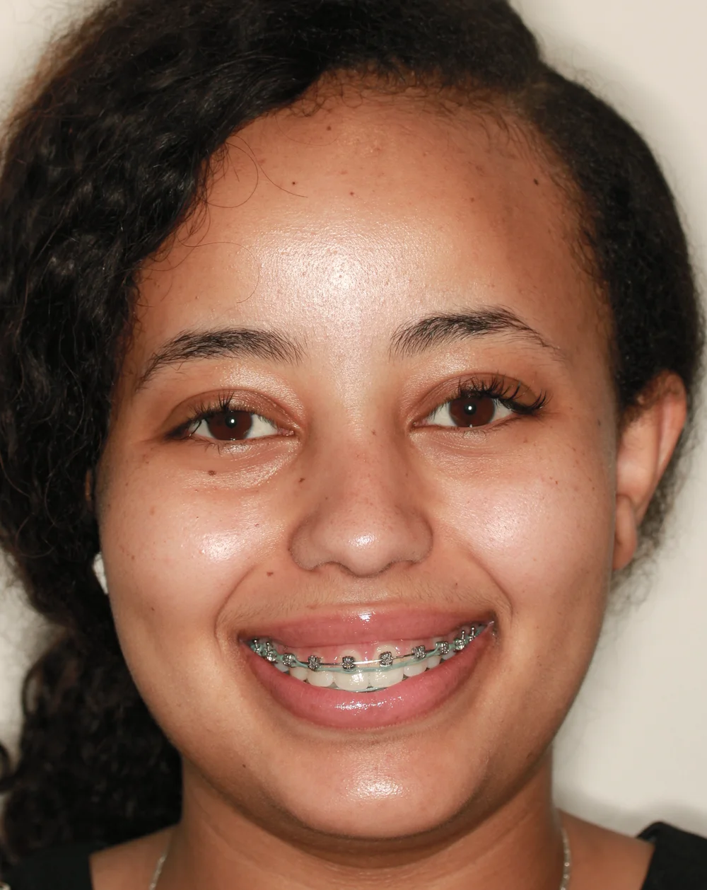 SAP bracket placement - brackets positioned closer to gumline