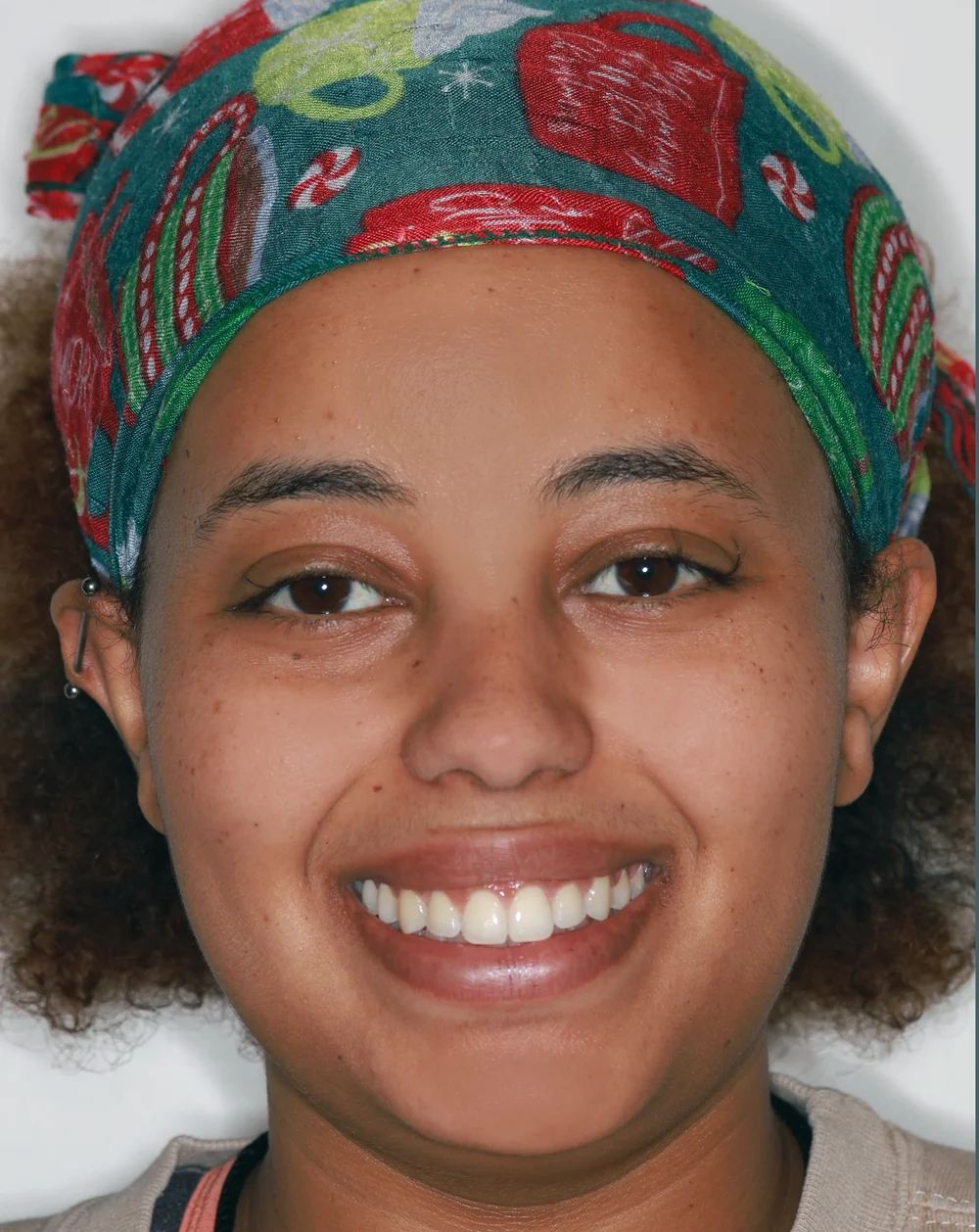 SAP final result - beautiful curved smile arc