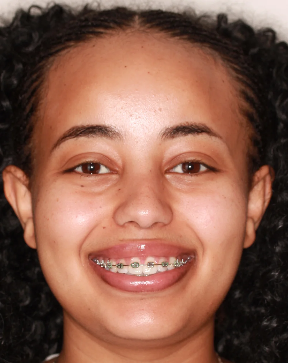 Traditional bracket placement - brackets centered on teeth